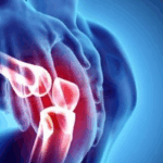 Degenerative Arthritis