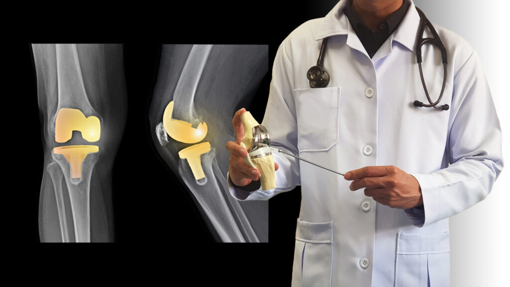 Doctor demonstrating knee joint replacement with model alongside X-ray images showing knee implants; educational visual for joint replacement surgery by orthopaedic specialist in Pune.