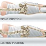 Person sleeping with pillow support to reduce lower back pain